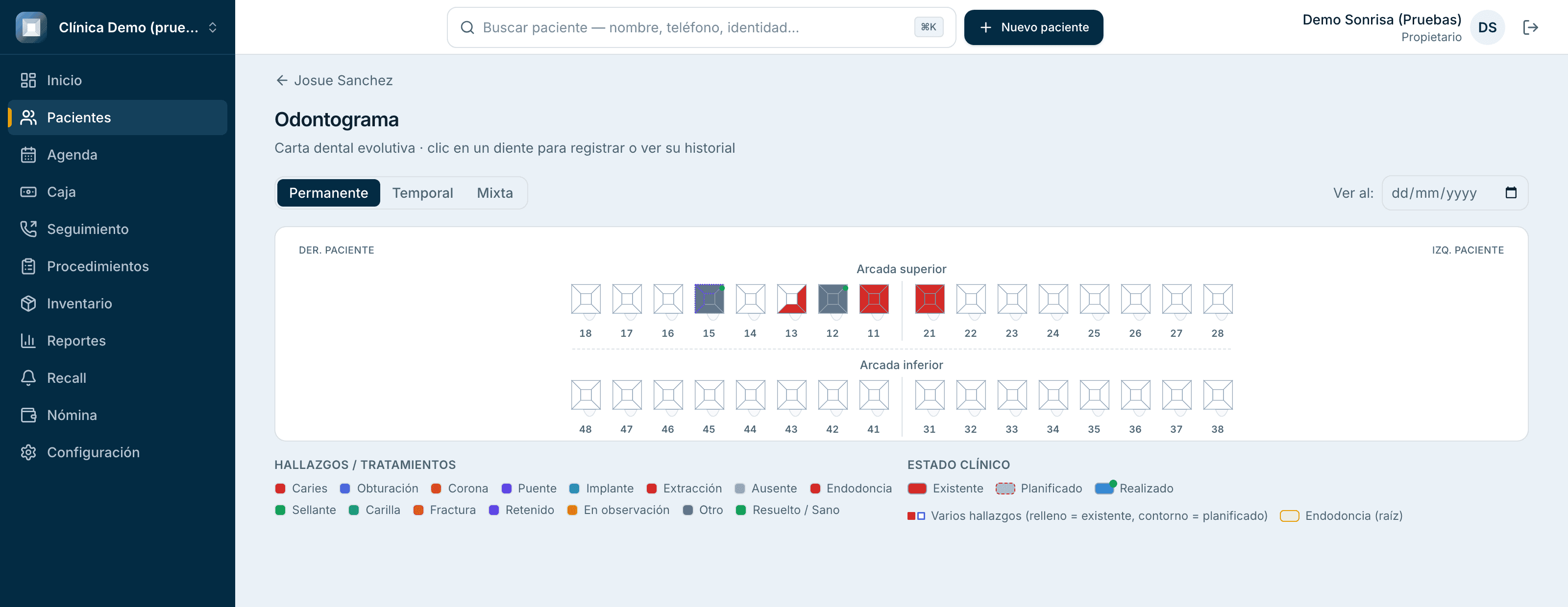 Odontograma evolutivo de un paciente en DentalMAX, con hallazgos y tratamientos por diente